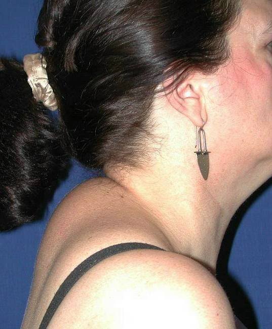 la bosse de bison (contexte: boule au niveau de la nuque)